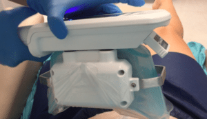 coolsculpting device