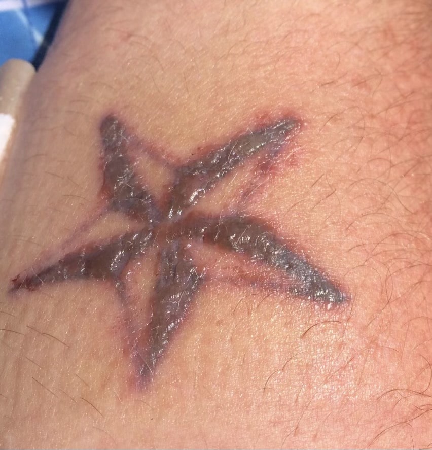 Tattoo Removal Harlingen Tx  Tattoo Removal Express