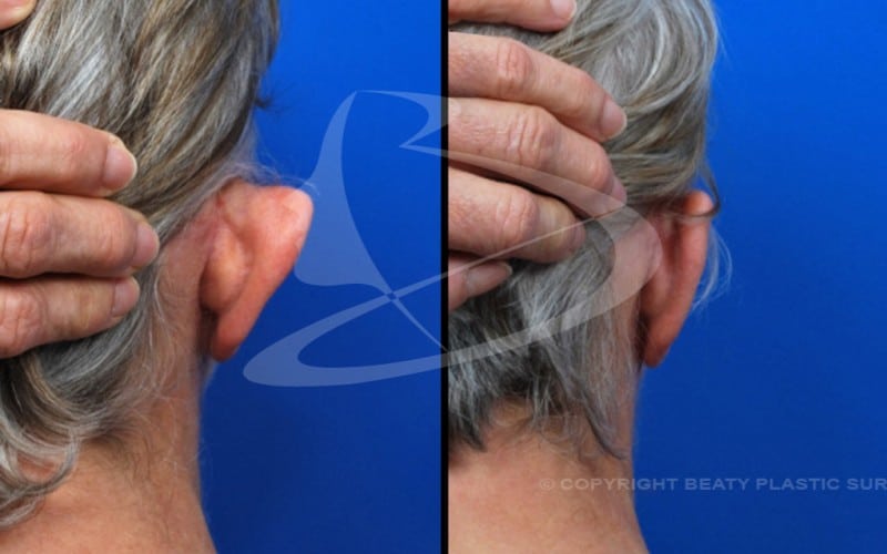 Otoplasty Ear Surgery Atlanta Alpharetta GA