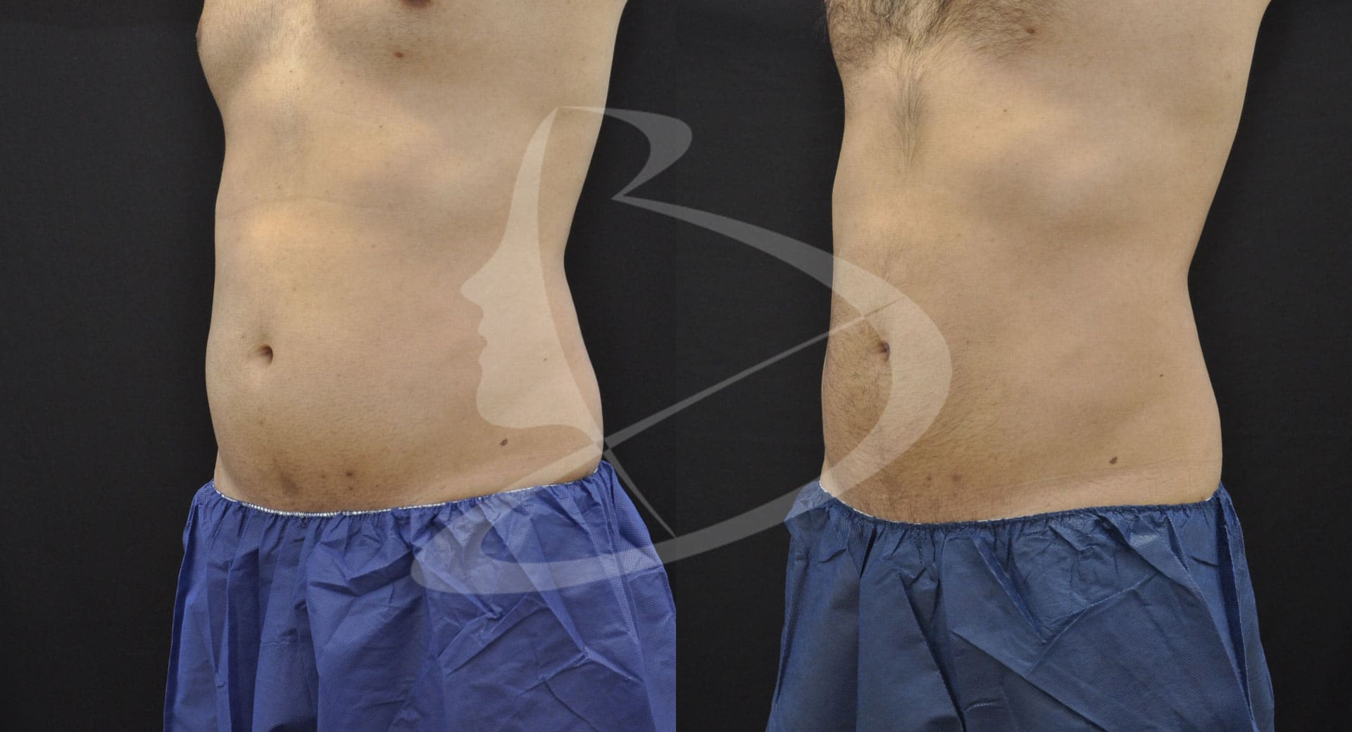 CoolSculpting® Specialists Atlanta | Non-Surgical Fat Reduction