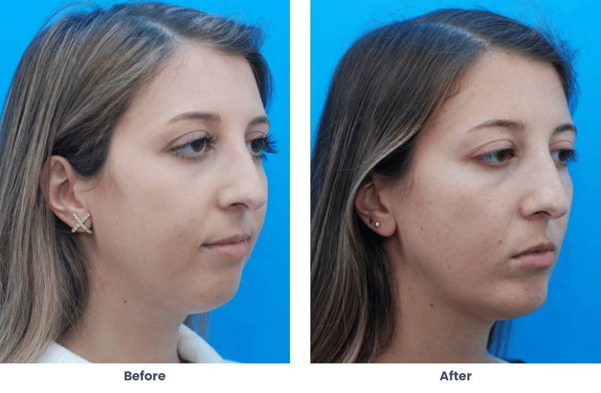 Facial Plastic Surgery Procedures Atlanta Alpharetta GA