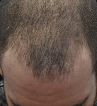 scalp prp for Hair Restoration