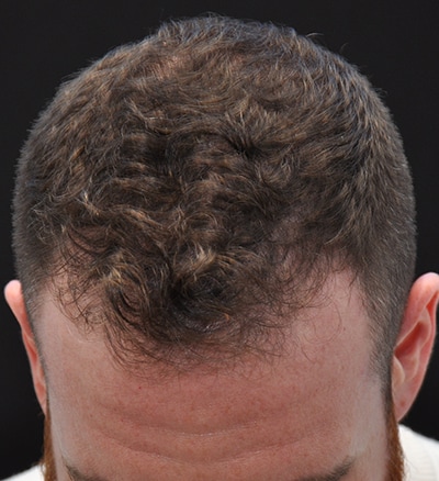 scalp prp for Hair Restoration