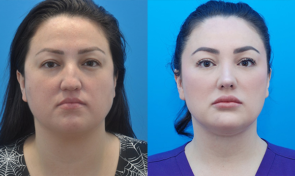 Before & After Buccal Fat Pad Removal Gallery Atlanta