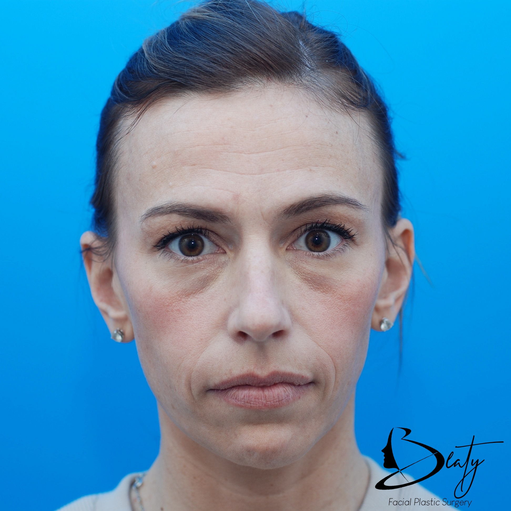 Upper blepharoplasty and brow lift