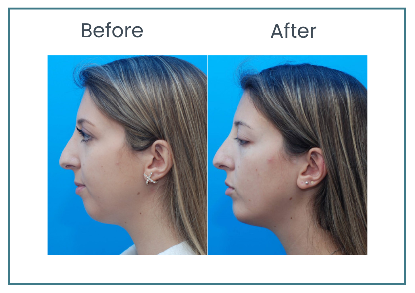 chin implant L featured BnA