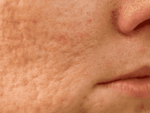 acne scars