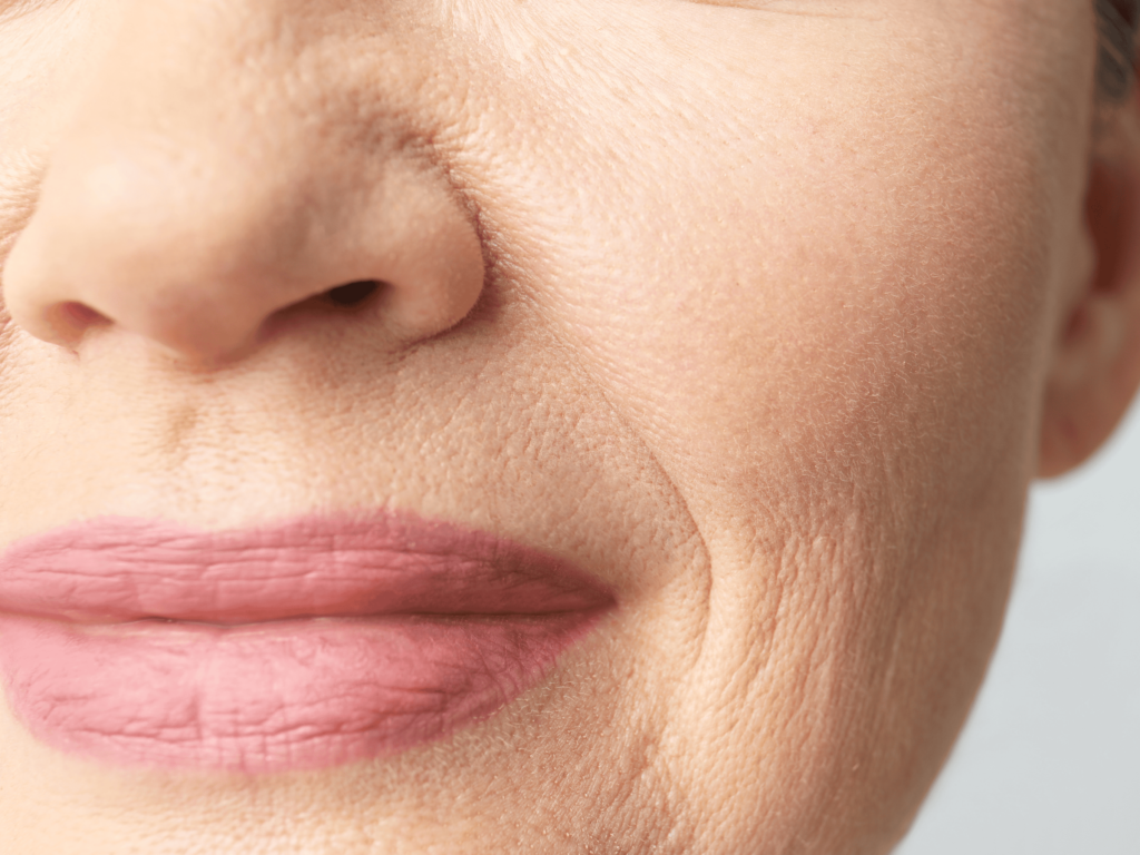 non-surgical lip lift