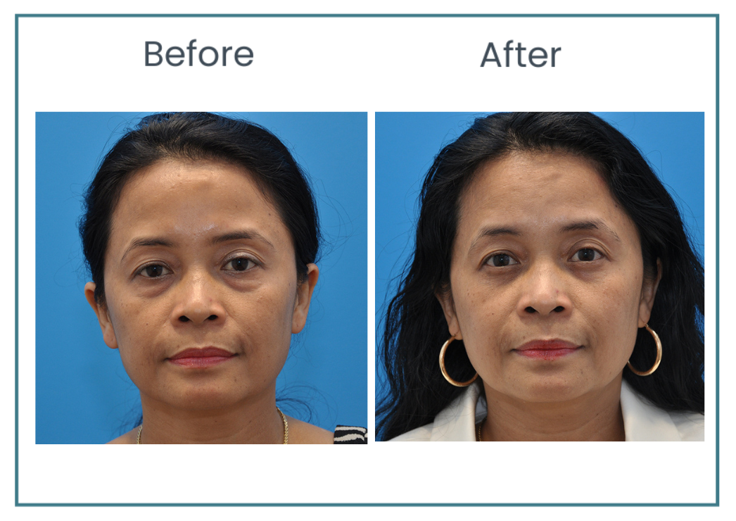 blepharoplasty before and after photos