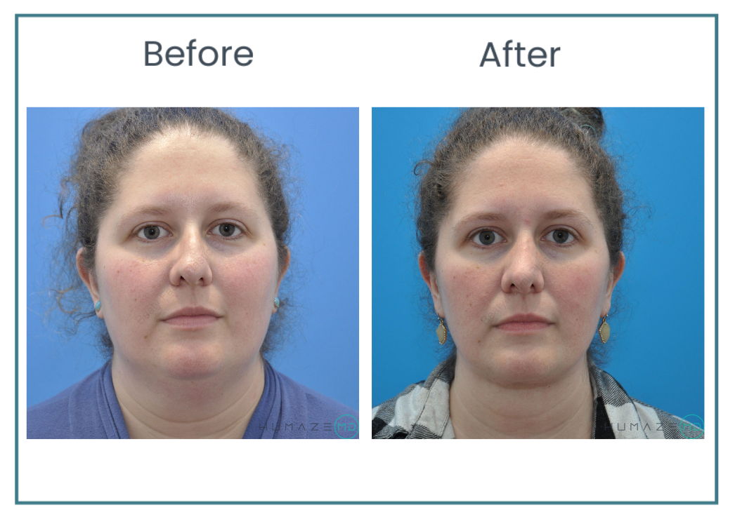 face liposuction before and after photos