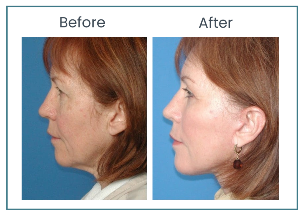 facelift before and after photos