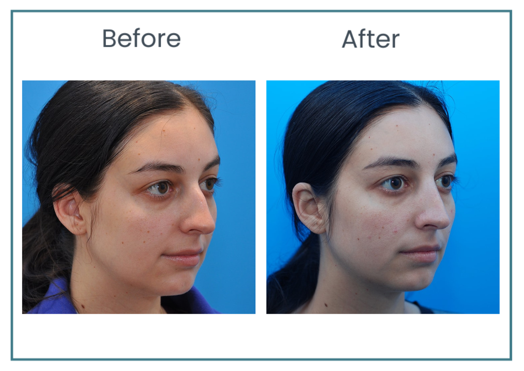 preservation rhinoplasty before and after photos