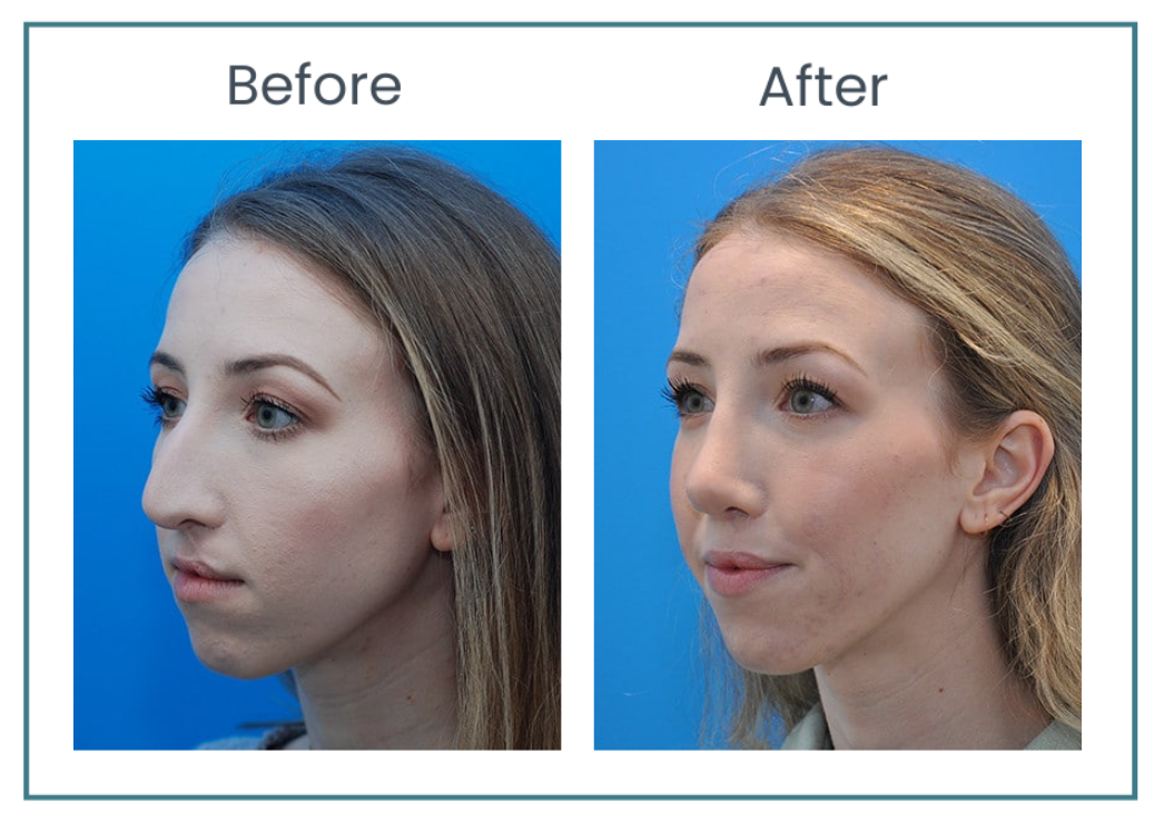 revision rhinoplasty before and after photos