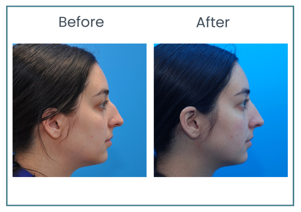 preservation rhinoplasty before and after