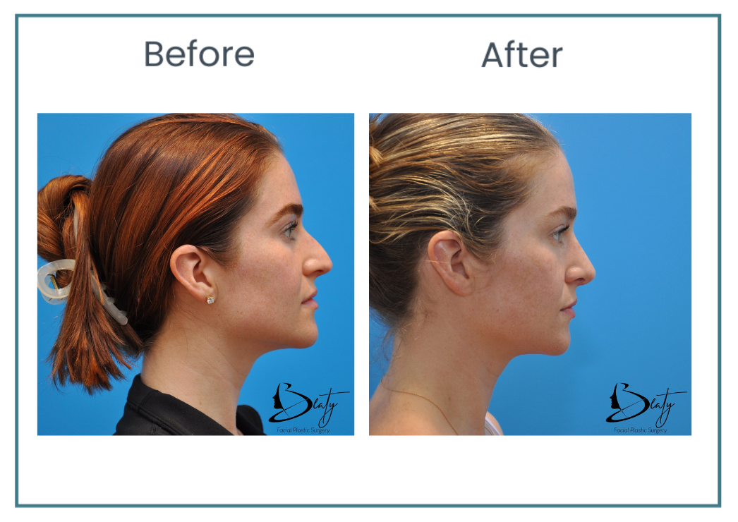 rhinoplasty before and after photos side by side