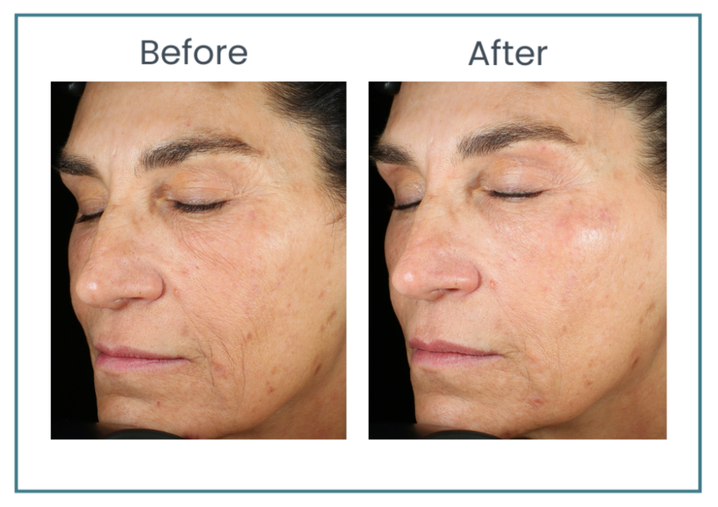 Ariessence Pure PDGF+ in Atlanta Alpharetta GA