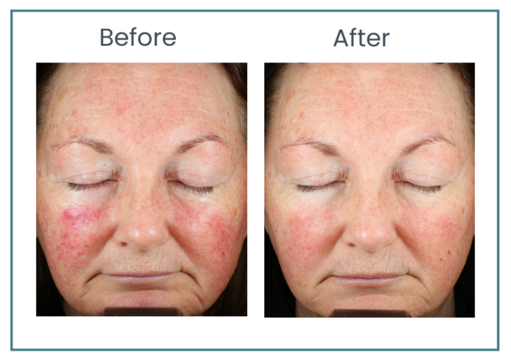 Ariessence Pure PDGF+ in Atlanta Alpharetta GA