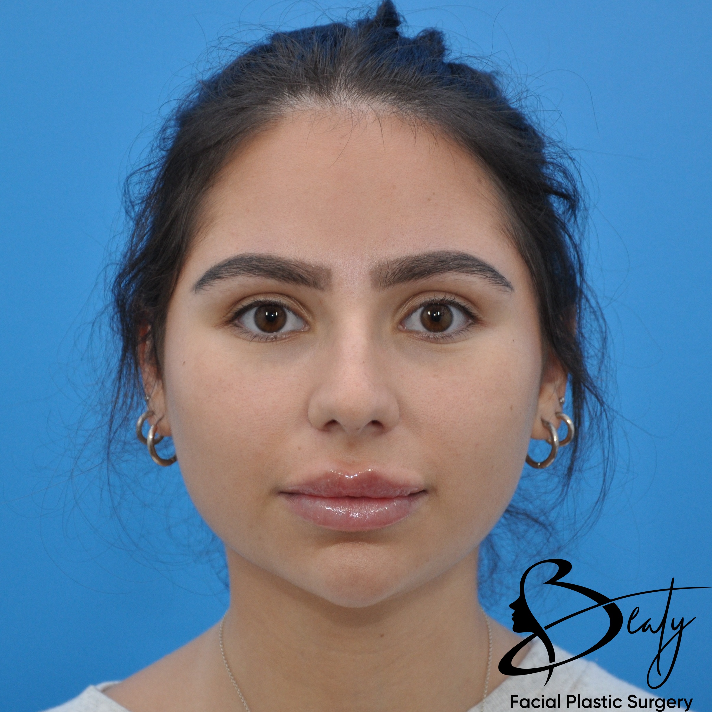 rhinoplasty & chin implant