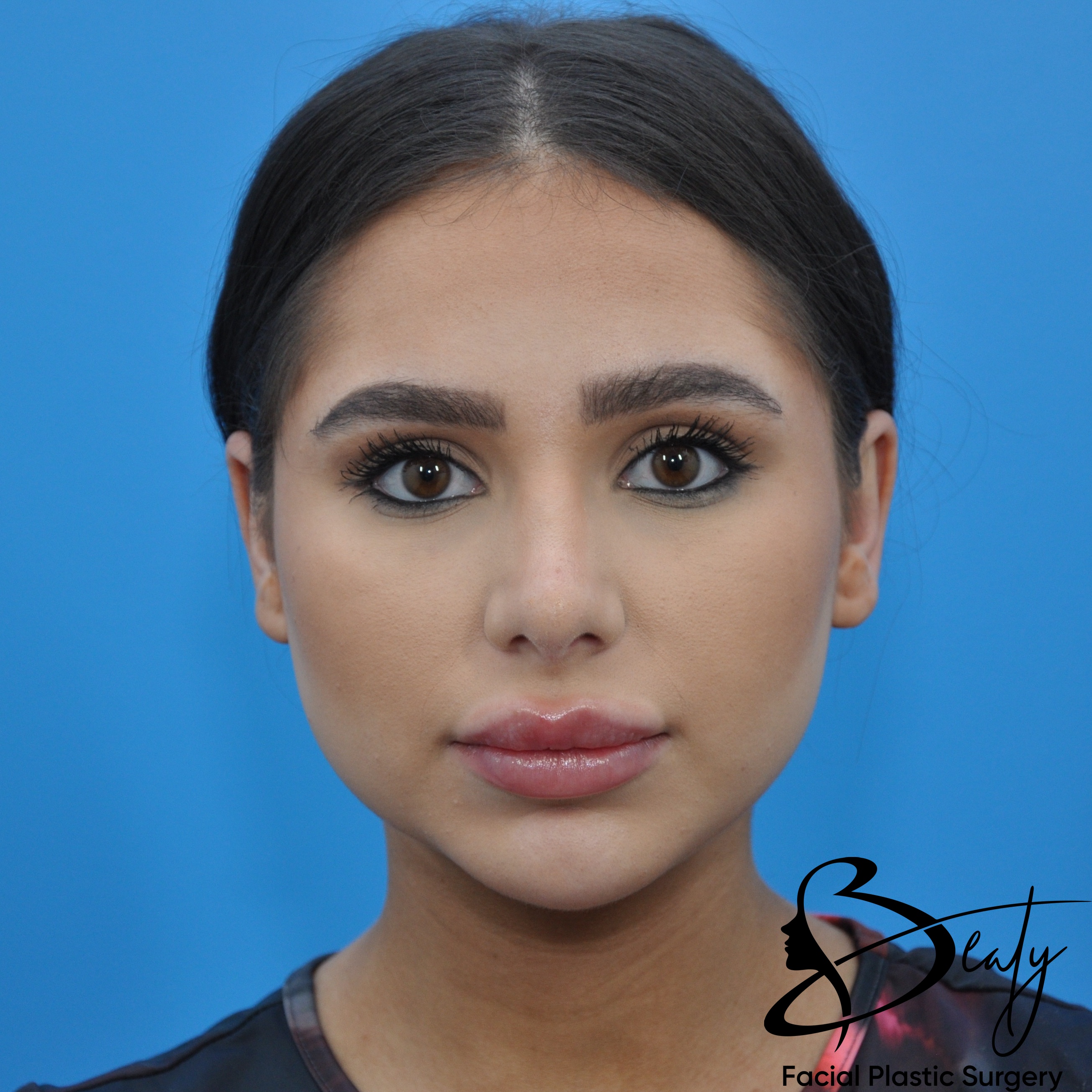 rhinoplasty & chin implant