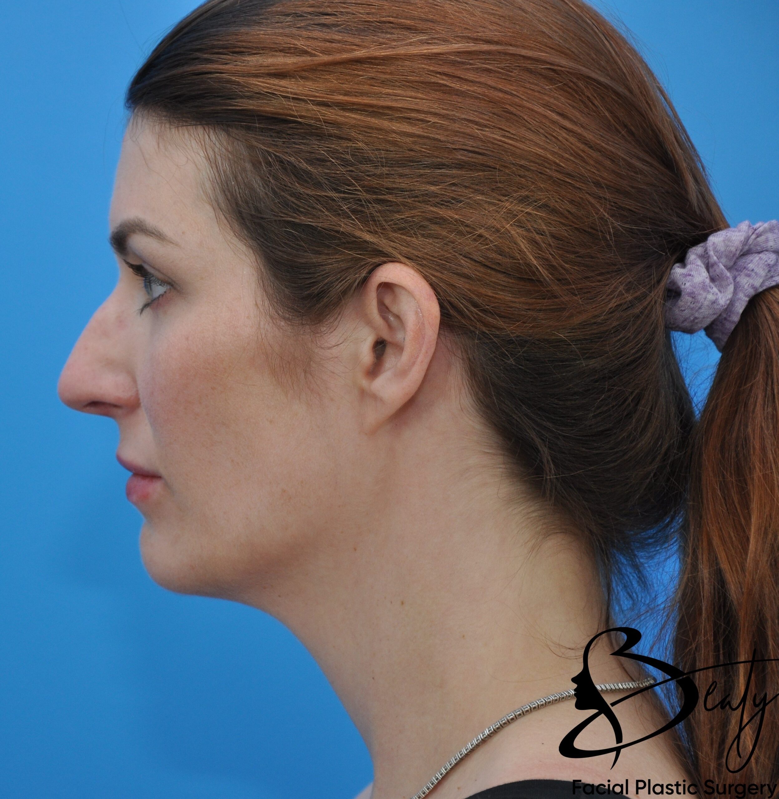 rhinoplasty