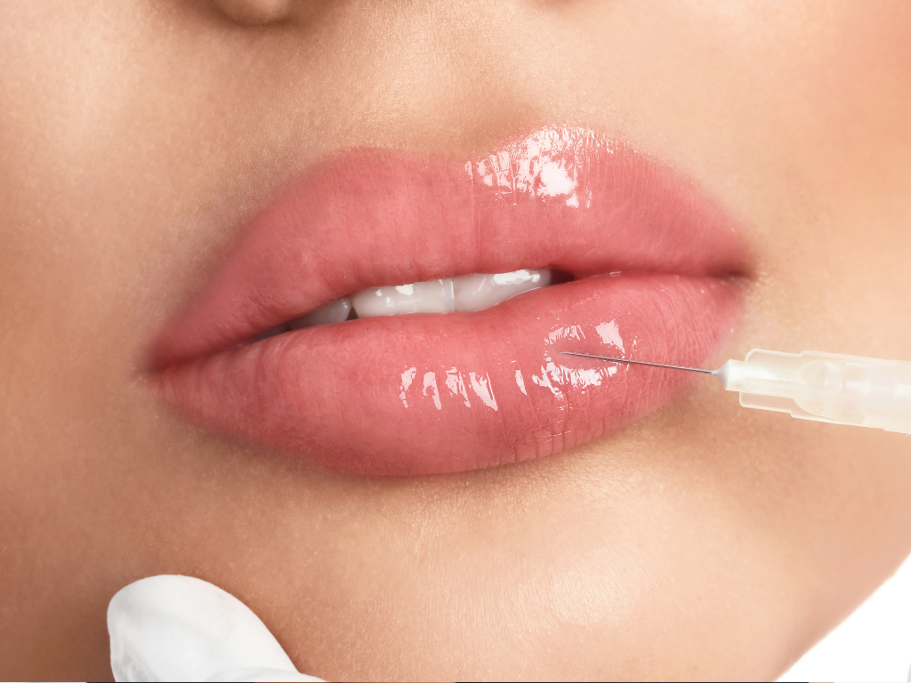 Before and after lip filler results for natural volume enhancement.