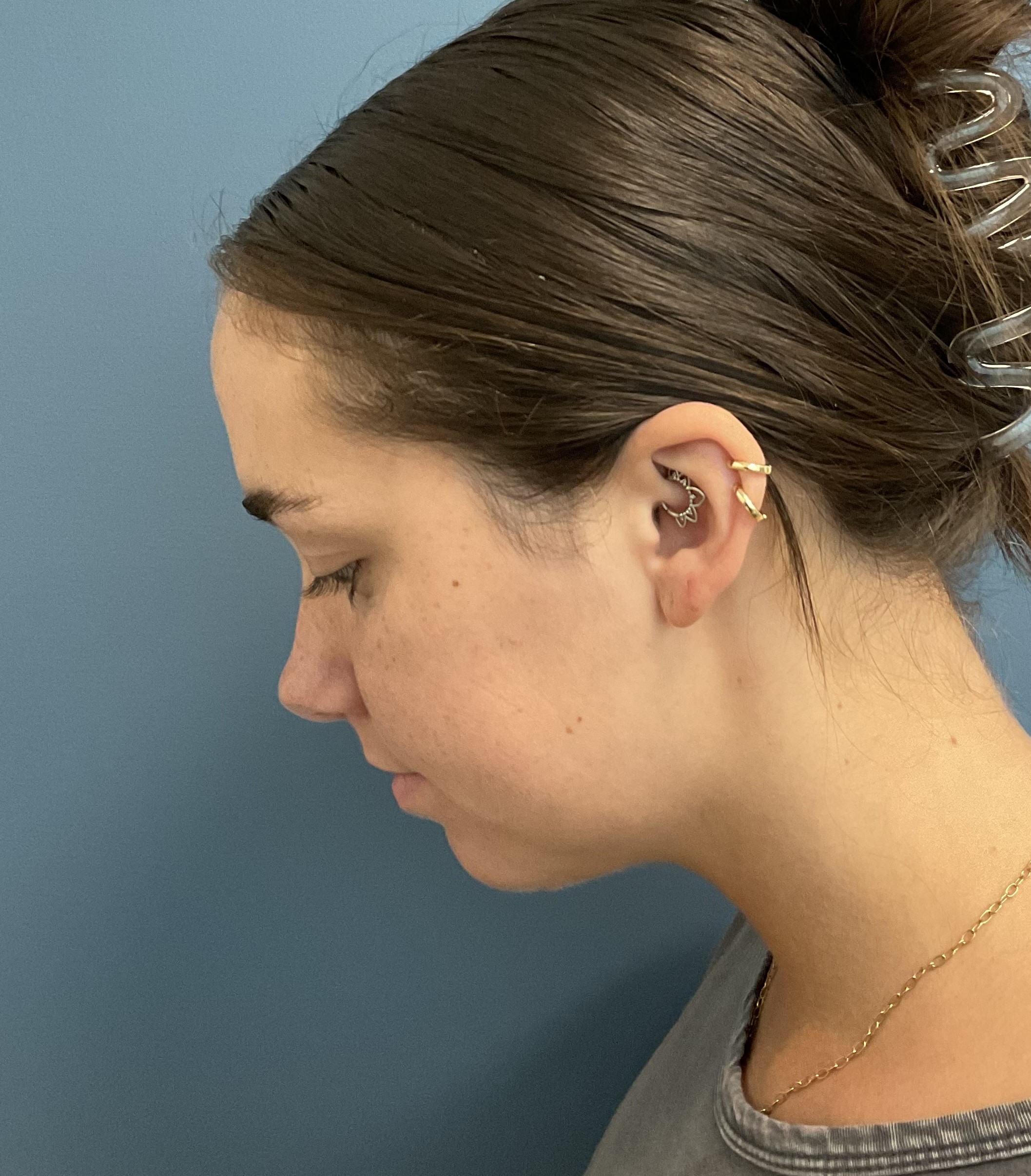 Neck Lift & Liposuction