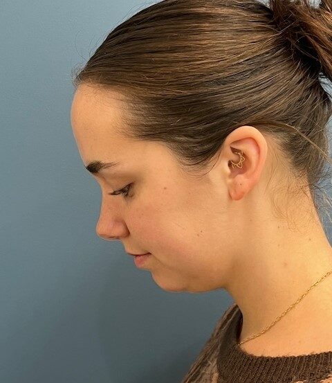Neck Lift & Liposuction