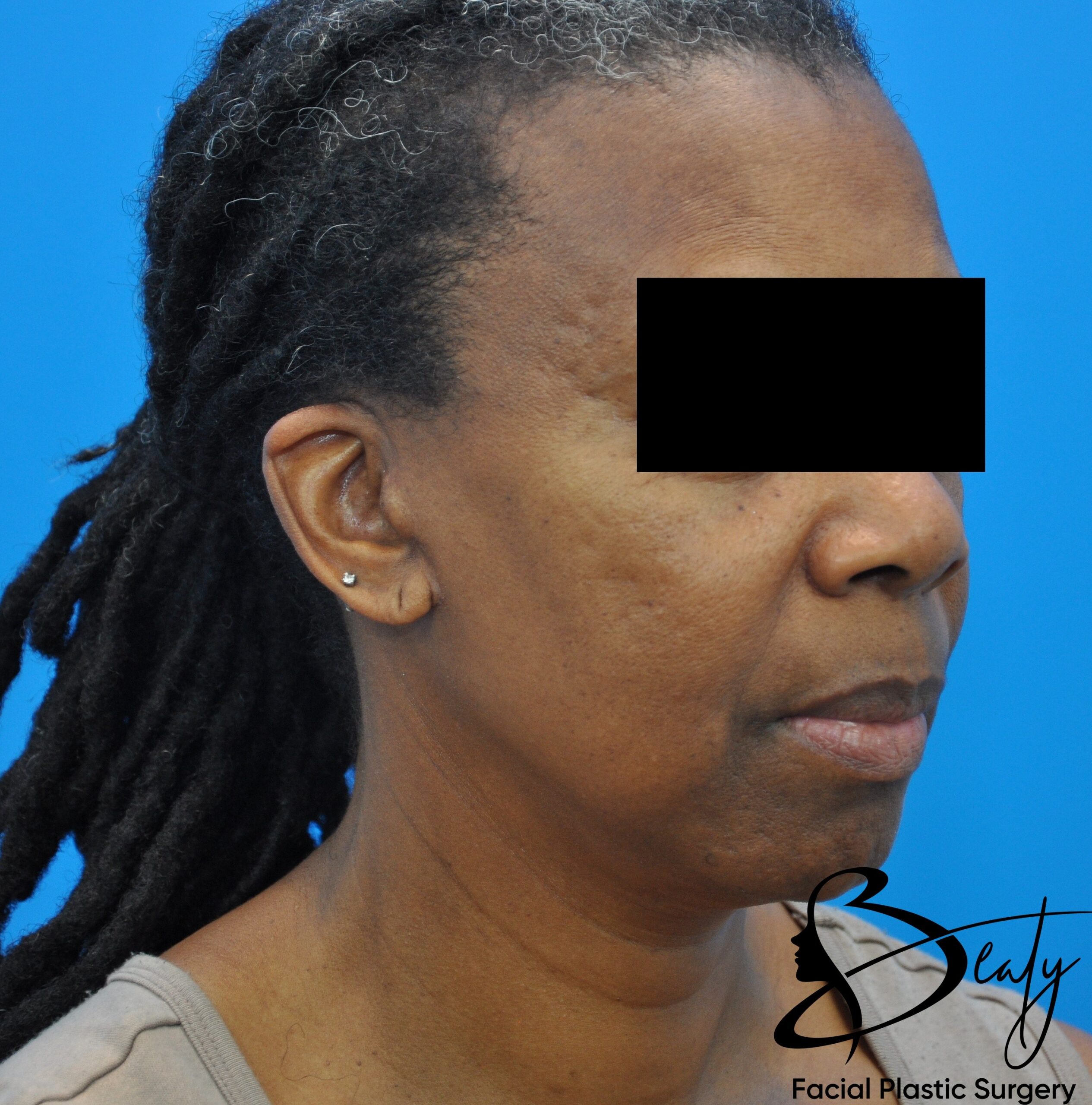 facelift