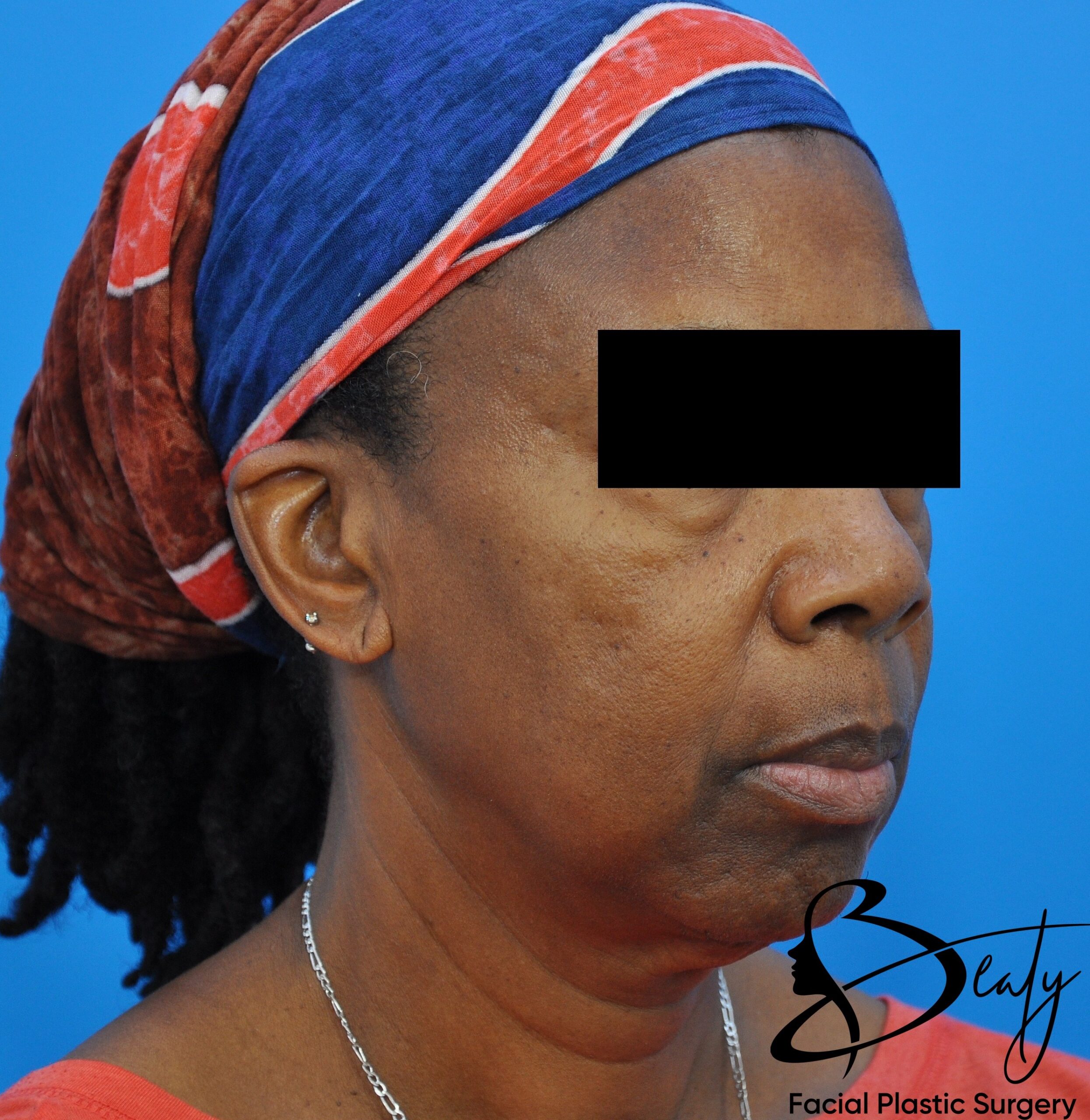 facelift