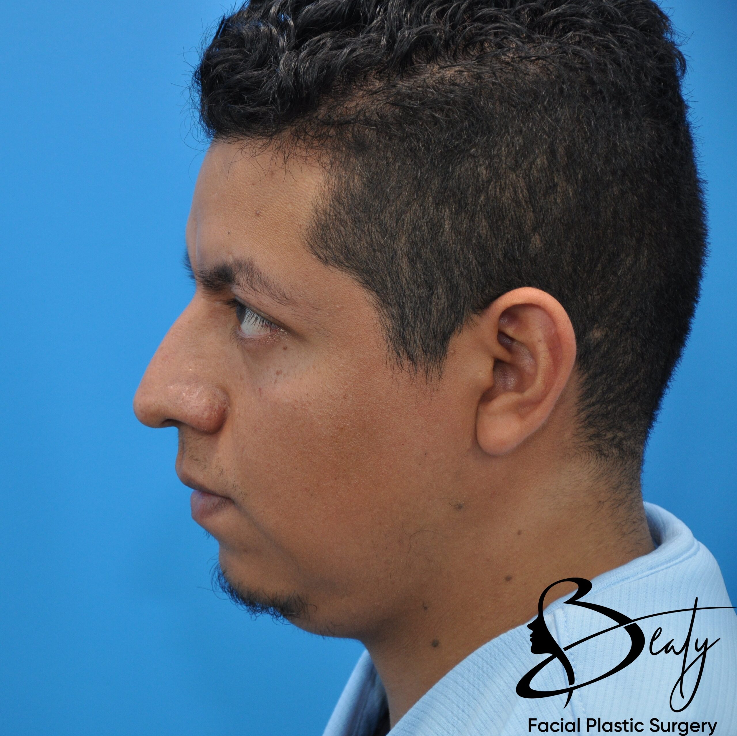 rhinoplasty