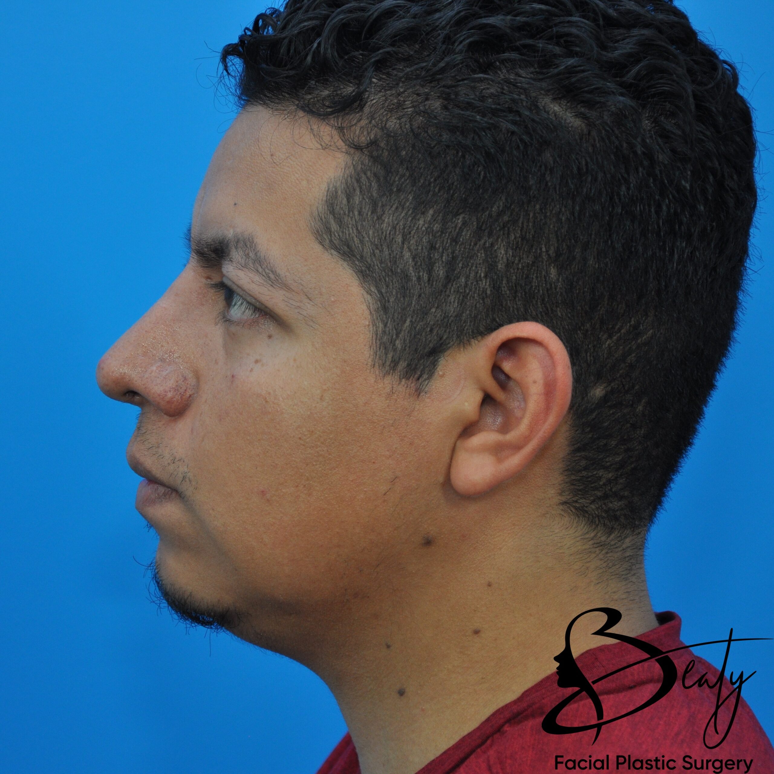 rhinoplasty