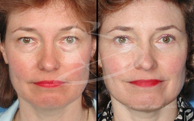 eyelid surgery atlanta