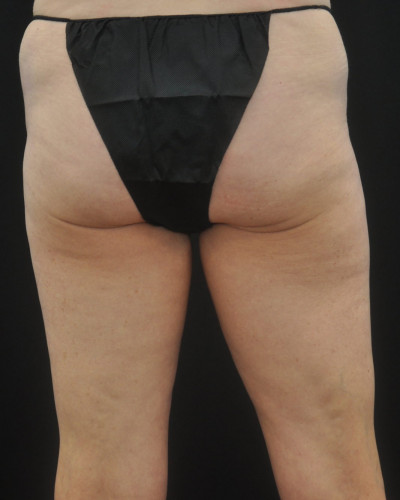 CoolSculpting Inner thighs